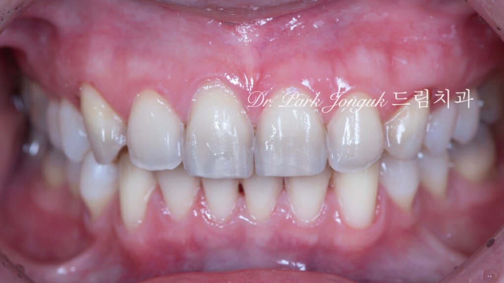 변색치아 라미네이트, Laminate for Discolored Teeth, 테트라사이클린 변색, Tetracycline Staining, 어두운 치아 라미네이트, Laminate for Dark Teeth, 항생제 변색, Antibiotic Staining, 내인성 변색, Intrinsic Discoloration, 변색 차폐, Discoloration Masking