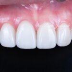 변색치아 라미네이트, Laminate for Discolored Teeth, 테트라사이클린 변색, Tetracycline Staining, 어두운 치아 라미네이트, Laminate for Dark Teeth, 항생제 변색, Antibiotic Staining, 내인성 변색, Intrinsic Discoloration, 변색 차폐, Discoloration Masking