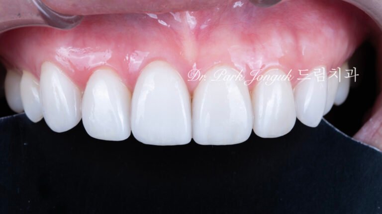 변색치아 라미네이트, Laminate for Discolored Teeth, 테트라사이클린 변색, Tetracycline Staining, 어두운 치아 라미네이트, Laminate for Dark Teeth, 항생제 변색, Antibiotic Staining, 내인성 변색, Intrinsic Discoloration, 변색 차폐, Discoloration Masking