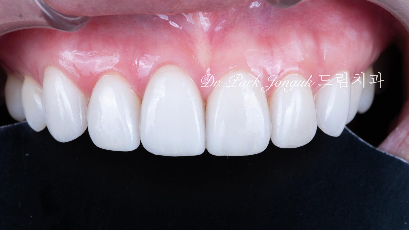 변색치아 라미네이트, Laminate for Discolored Teeth, 테트라사이클린 변색, Tetracycline Staining, 어두운 치아 라미네이트, Laminate for Dark Teeth, 항생제 변색, Antibiotic Staining, 내인성 변색, Intrinsic Discoloration, 변색 차폐, Discoloration Masking