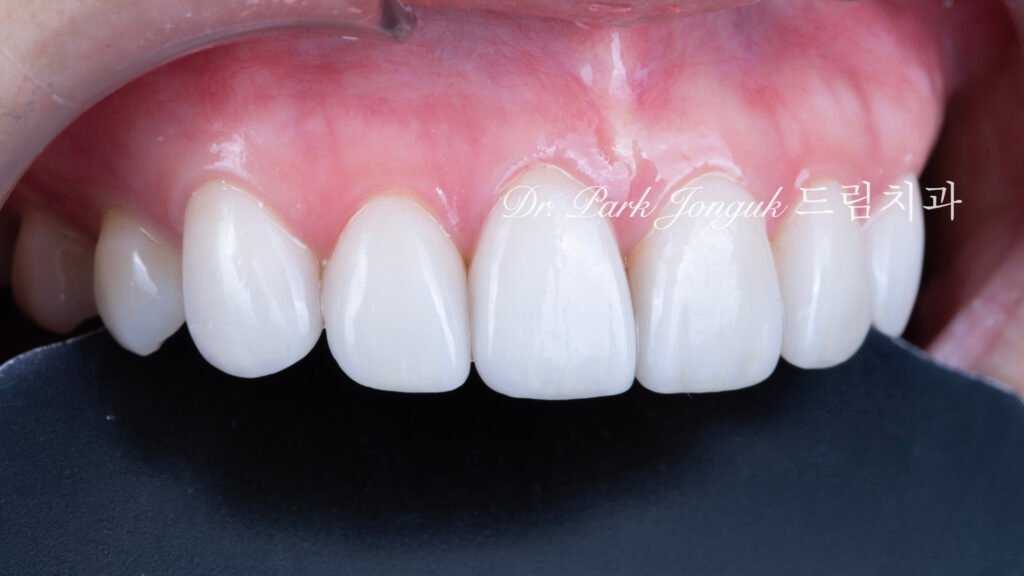 변색치아 라미네이트, Laminate for Discolored Teeth, 테트라사이클린 변색, Tetracycline Staining, 어두운 치아 라미네이트, Laminate for Dark Teeth, 항생제 변색, Antibiotic Staining, 내인성 변색, Intrinsic Discoloration, 변색 차폐, Discoloration Masking