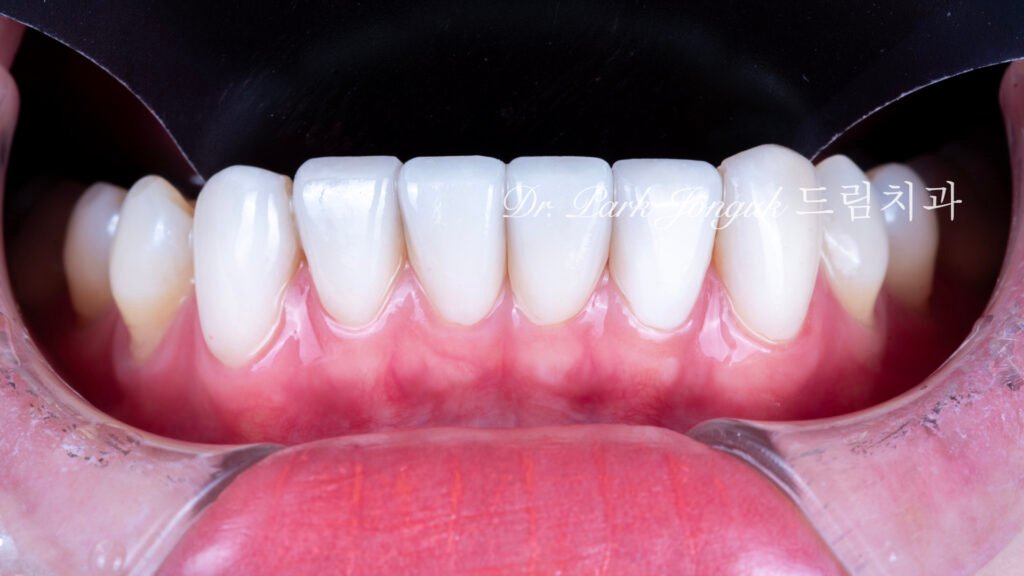 변색치아 라미네이트, Laminate for Discolored Teeth, 테트라사이클린 변색, Tetracycline Staining, 어두운 치아 라미네이트, Laminate for Dark Teeth, 항생제 변색, Antibiotic Staining, 내인성 변색, Intrinsic Discoloration, 변색 차폐, Discoloration Masking