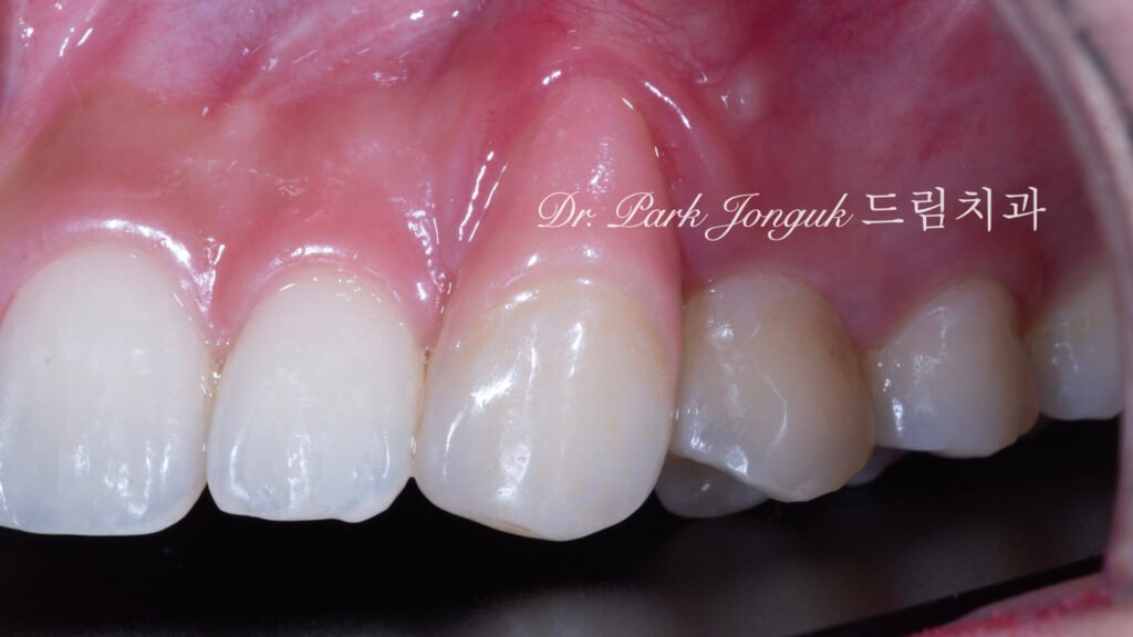 잇몸 라미네이트, Gingival Laminate, 핑크 라미네이트, Pink Laminate, 잇몸 재현, Gingival Reproduction, 핑크 포셀레인, Pink Porcelain, 치은 퇴축, Gingival Recession, 구순구개열, Cleft Lip and Palate