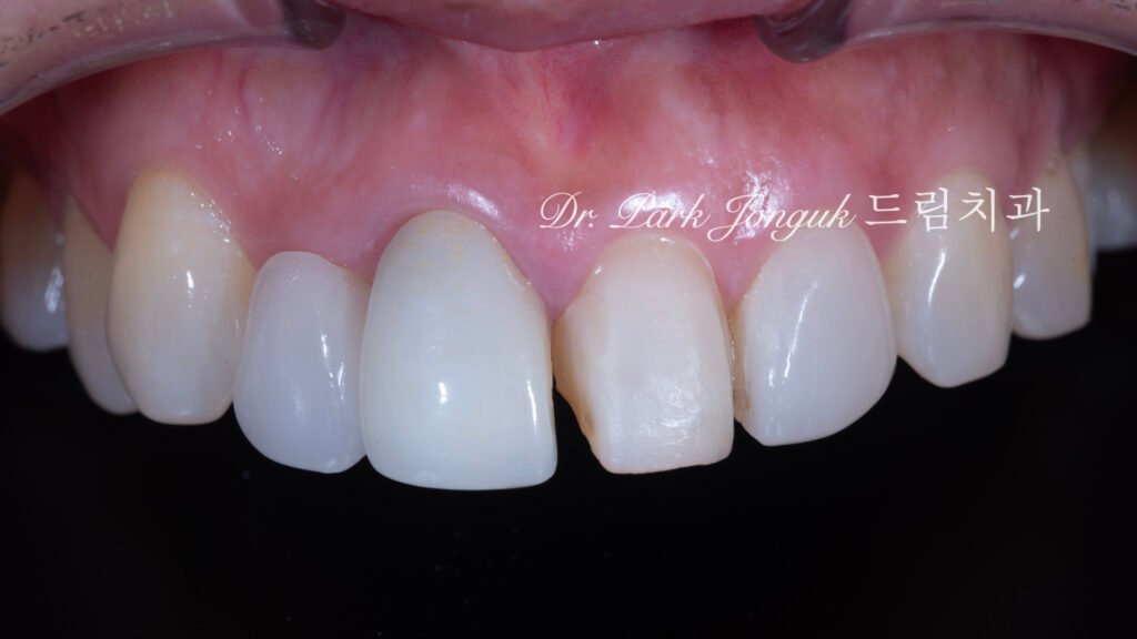 잇몸 라미네이트, Gingival Laminate, 핑크 라미네이트, Pink Laminate, 잇몸 재현, Gingival Reproduction, 핑크 포셀레인, Pink Porcelain, 치은 퇴축, Gingival Recession, 구순구개열, Cleft Lip and Palate