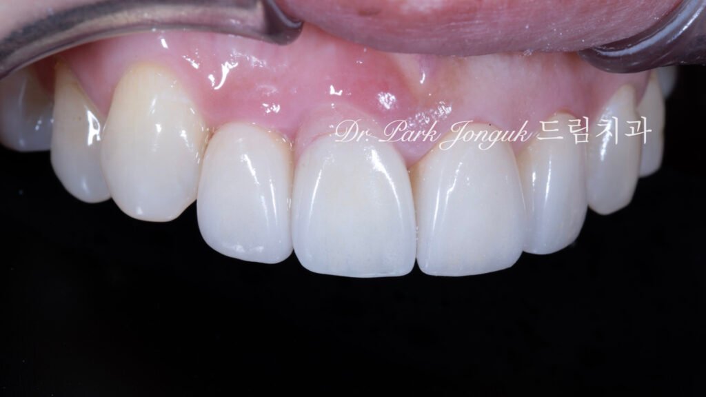 잇몸 라미네이트, Gingival Laminate, 핑크 라미네이트, Pink Laminate, 잇몸 재현, Gingival Reproduction, 핑크 포셀레인, Pink Porcelain, 치은 퇴축, Gingival Recession, 구순구개열, Cleft Lip and Palate