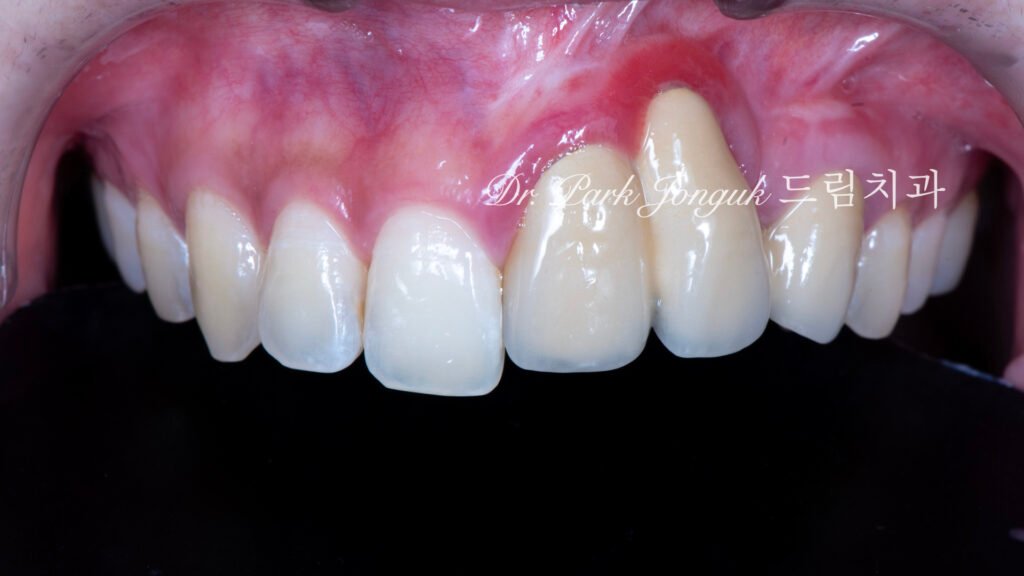 잇몸 라미네이트, Gingival Laminate, 핑크 라미네이트, Pink Laminate, 잇몸 재현, Gingival Reproduction, 핑크 포셀레인, Pink Porcelain, 치은 퇴축, Gingival Recession, 구순구개열, Cleft Lip and Palate