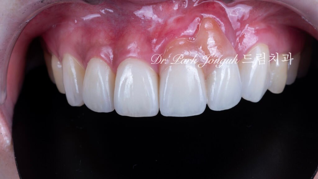 잇몸 라미네이트, Gingival Laminate, 핑크 라미네이트, Pink Laminate, 잇몸 재현, Gingival Reproduction, 핑크 포셀레인, Pink Porcelain, 치은 퇴축, Gingival Recession, 구순구개열, Cleft Lip and Palate