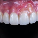 잇몸 라미네이트, Gingival Laminate, 핑크 라미네이트, Pink Laminate, 잇몸 재현, Gingival Reproduction, 핑크 포셀레인, Pink Porcelain, 치은 퇴축, Gingival Recession, 구순구개열, Cleft Lip and Palate