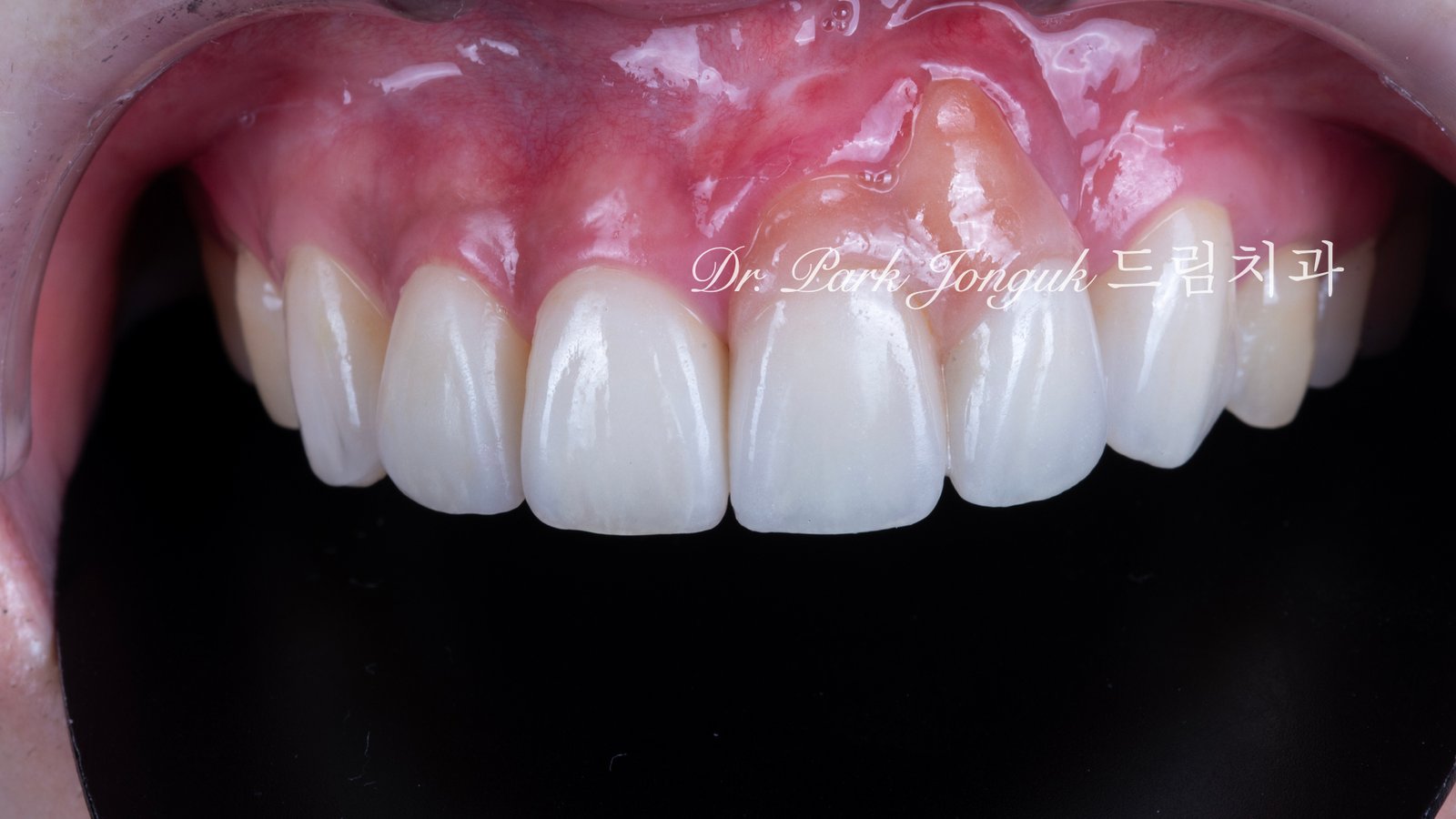 잇몸 라미네이트, Gingival Laminate, 핑크 라미네이트, Pink Laminate, 잇몸 재현, Gingival Reproduction, 핑크 포셀레인, Pink Porcelain, 치은 퇴축, Gingival Recession, 구순구개열, Cleft Lip and Palate