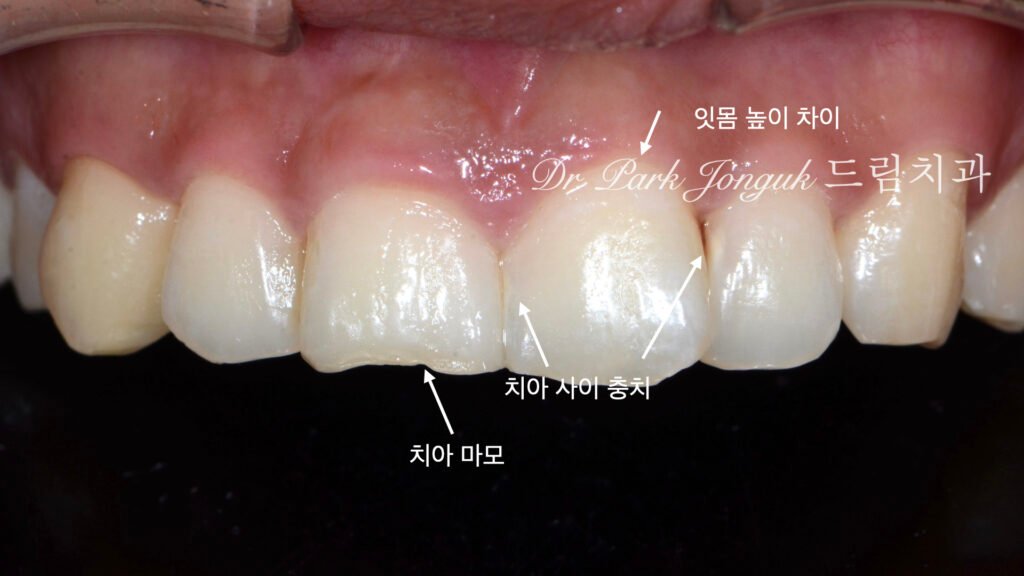앞니 라미네이트, Anterior Laminate, 강남 라미네이트, Gangnam Laminate, 라미네이트 잘하는 곳, Best Laminate Clinic, 치은 성형, Gingivectomy, 왁스업 진단, Diagnostic Wax-up, 수작업 빌드업, Hand-Layered Build-up