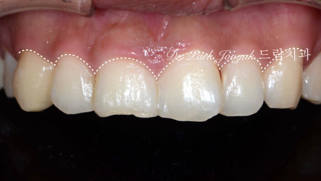 앞니 라미네이트, Anterior Laminate, 강남 라미네이트, Gangnam Laminate, 라미네이트 잘하는 곳, Best Laminate Clinic, 치은 성형, Gingivectomy, 왁스업 진단, Diagnostic Wax-up, 수작업 빌드업, Hand-Layered Build-up