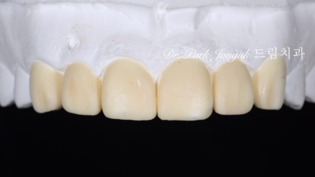 앞니 라미네이트, Anterior Laminate, 강남 라미네이트, Gangnam Laminate, 라미네이트 잘하는 곳, Best Laminate Clinic, 치은 성형, Gingivectomy, 왁스업 진단, Diagnostic Wax-up, 수작업 빌드업, Hand-Layered Build-up