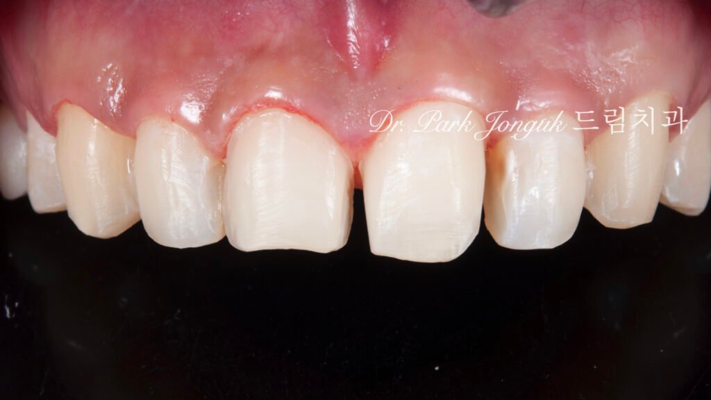 앞니 라미네이트, Anterior Laminate, 강남 라미네이트, Gangnam Laminate, 라미네이트 잘하는 곳, Best Laminate Clinic, 치은 성형, Gingivectomy, 왁스업 진단, Diagnostic Wax-up, 수작업 빌드업, Hand-Layered Build-up