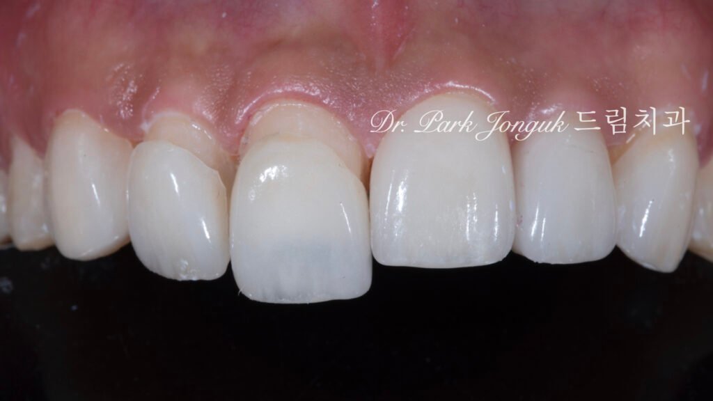 앞니 라미네이트, Anterior Laminate, 강남 라미네이트, Gangnam Laminate, 라미네이트 잘하는 곳, Best Laminate Clinic, 치은 성형, Gingivectomy, 왁스업 진단, Diagnostic Wax-up, 수작업 빌드업, Hand-Layered Build-up