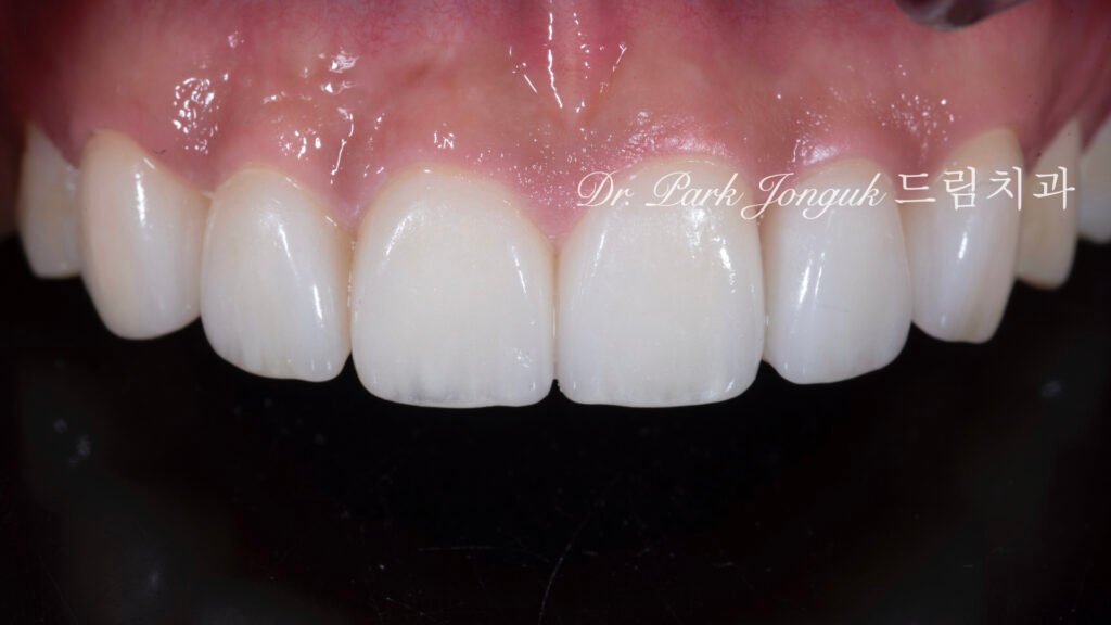 앞니 라미네이트, Anterior Laminate, 강남 라미네이트, Gangnam Laminate, 라미네이트 잘하는 곳, Best Laminate Clinic, 치은 성형, Gingivectomy, 왁스업 진단, Diagnostic Wax-up, 수작업 빌드업, Hand-Layered Build-up
