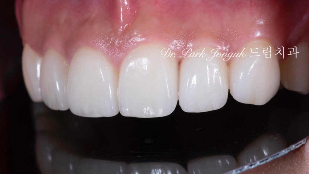 앞니 라미네이트, Anterior Laminate, 강남 라미네이트, Gangnam Laminate, 라미네이트 잘하는 곳, Best Laminate Clinic, 치은 성형, Gingivectomy, 왁스업 진단, Diagnostic Wax-up, 수작업 빌드업, Hand-Layered Build-up