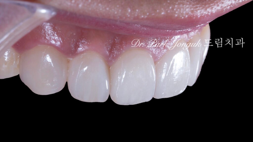 앞니 라미네이트, Anterior Laminate, 강남 라미네이트, Gangnam Laminate, 라미네이트 잘하는 곳, Best Laminate Clinic, 치은 성형, Gingivectomy, 왁스업 진단, Diagnostic Wax-up, 수작업 빌드업, Hand-Layered Build-up