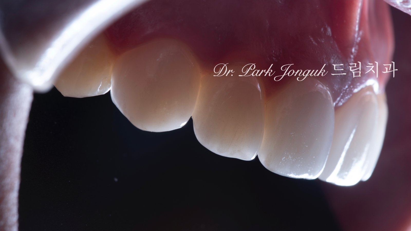 앞니 라미네이트, Anterior Laminate, 강남 라미네이트, Gangnam Laminate, 라미네이트 잘하는 곳, Best Laminate Clinic, 치은 성형, Gingivectomy, 왁스업 진단, Diagnostic Wax-up, 수작업 빌드업, Hand-Layered Build-up