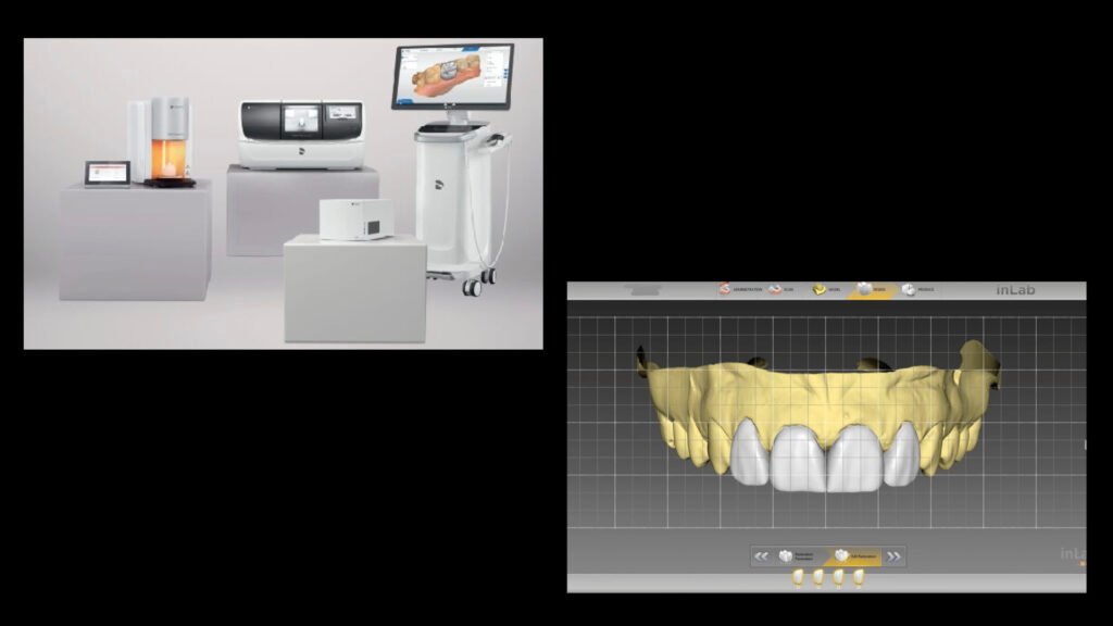 앞니 라미네이트, Anterior Laminate, 라미네이트 잘하는 곳, Best Laminate Clinic, 라미네이트 종류, Types of Laminate, 라미네이트 제작 과정, Laminate Fabrication Process, 핸드메이드 빌드업, Hand-Layered Build-up, 원데이 라미네이트, One-Day Laminate