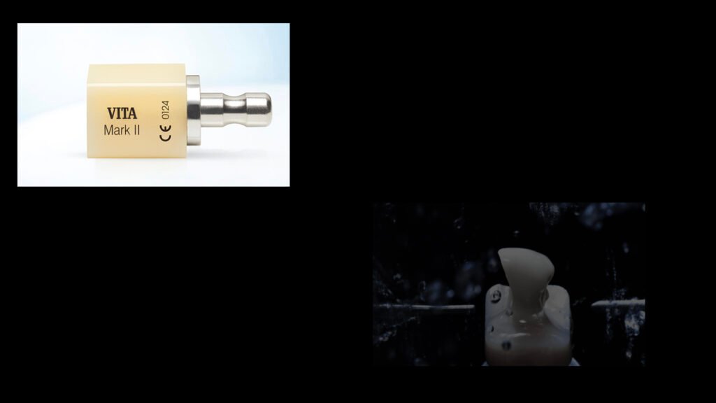 앞니 라미네이트, Anterior Laminate, 라미네이트 잘하는 곳, Best Laminate Clinic, 라미네이트 종류, Types of Laminate, 라미네이트 제작 과정, Laminate Fabrication Process, 핸드메이드 빌드업, Hand-Layered Build-up, 원데이 라미네이트, One-Day Laminate