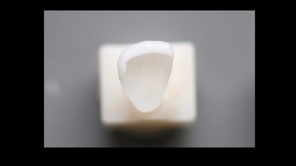 앞니 라미네이트, Anterior Laminate, 라미네이트 잘하는 곳, Best Laminate Clinic, 라미네이트 종류, Types of Laminate, 라미네이트 제작 과정, Laminate Fabrication Process, 핸드메이드 빌드업, Hand-Layered Build-up, 원데이 라미네이트, One-Day Laminate