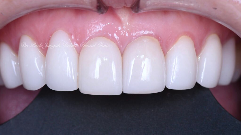 앞니 라미네이트, Anterior Laminate, 라미네이트 잘하는 곳, Best Laminate Clinic, 라미네이트 종류, Types of Laminate, 라미네이트 제작 과정, Laminate Fabrication Process, 핸드메이드 빌드업, Hand-Layered Build-up, 원데이 라미네이트, One-Day Laminate