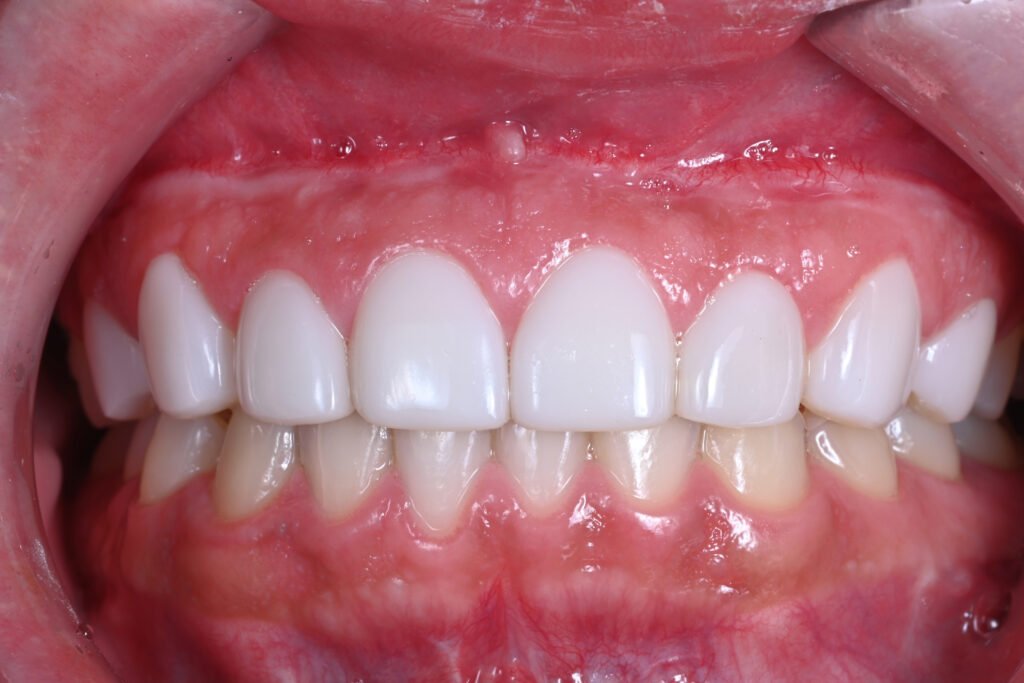 앞니 라미네이트, Anterior Laminate, 라미네이트 잘하는 곳, Best Laminate Clinic, 라미네이트 종류, Types of Laminate, 라미네이트 제작 과정, Laminate Fabrication Process, 핸드메이드 빌드업, Hand-Layered Build-up, 원데이 라미네이트, One-Day Laminate