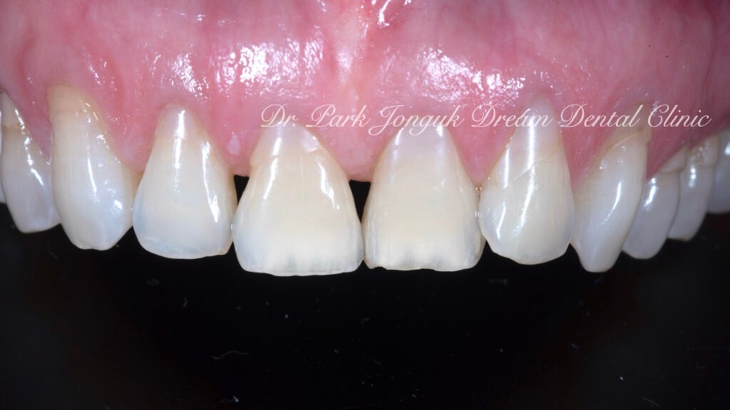 노화 치아 라미네이트, Aging Tooth Laminate, 50대 라미네이트, 60대 라미네이트, 법랑질 손실, Enamel Loss, Biomimetic, 생체모방 치과학, 치아 노화, Tooth Aging