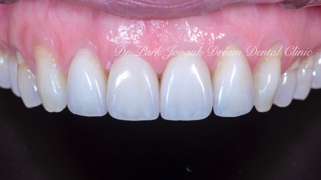 노화 치아 라미네이트, Aging Tooth Laminate, 50대 라미네이트, 60대 라미네이트, 법랑질 손실, Enamel Loss, Biomimetic, 생체모방 치과학, 치아 노화, Tooth Aging