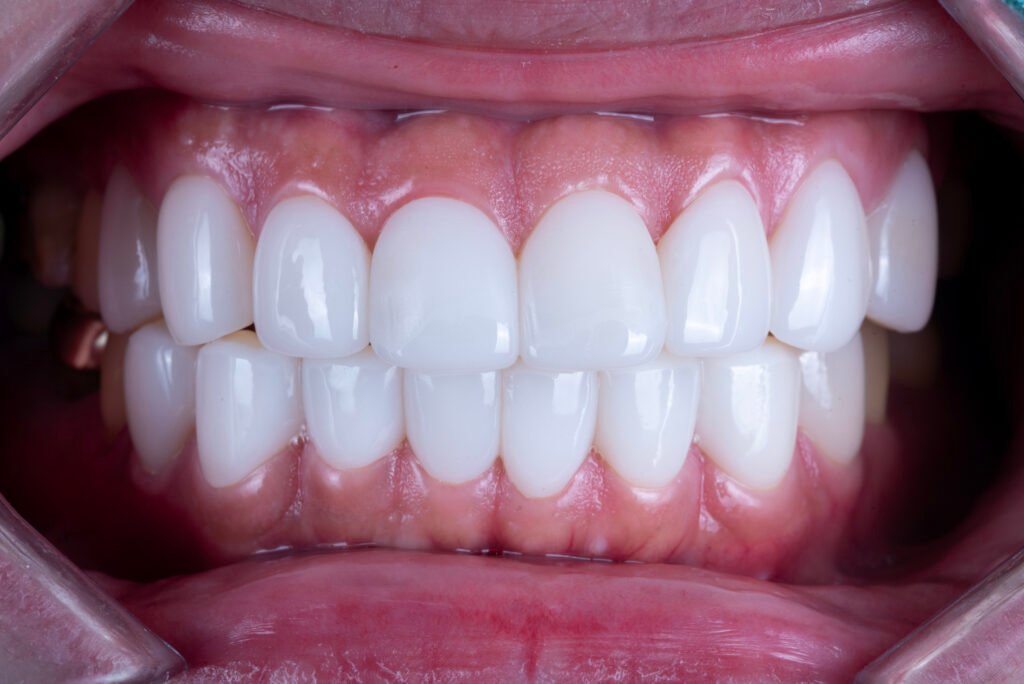 앞니 라미네이트, Anterior Laminate, 라미네이트 잘하는 곳, Best Laminate Clinic, 라미네이트 종류, Types of Laminate, 라미네이트 제작 과정, Laminate Fabrication Process, 핸드메이드 빌드업, Hand-Layered Build-up, 원데이 라미네이트, One-Day Laminate