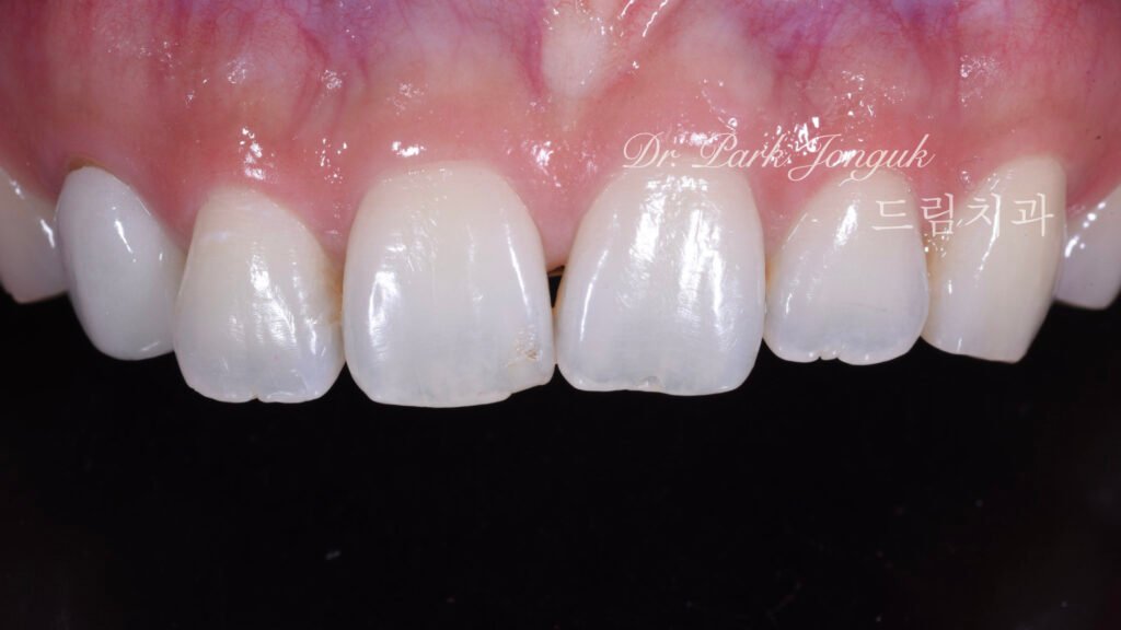 교정 후 라미네이트, Post-Orthodontic Laminate, 치아 축 기울기, Tooth Axis Inclination, 비대칭 교합 평면, Asymmetric Occlusal Plane, 교정 후 불만족, Post-Orthodontic Dissatisfaction, 치아 형태 보정, Tooth Morphology Correction