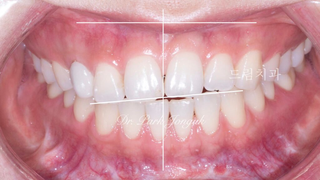 교정 후 라미네이트, Post-Orthodontic Laminate, 치아 축 기울기, Tooth Axis Inclination, 비대칭 교합 평면, Asymmetric Occlusal Plane, 교정 후 불만족, Post-Orthodontic Dissatisfaction, 치아 형태 보정, Tooth Morphology Correction