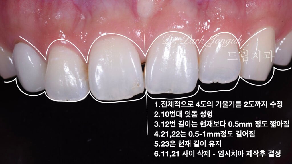 교정 후 라미네이트, Post-Orthodontic Laminate, 치아 축 기울기, Tooth Axis Inclination, 비대칭 교합 평면, Asymmetric Occlusal Plane, 교정 후 불만족, Post-Orthodontic Dissatisfaction, 치아 형태 보정, Tooth Morphology Correction