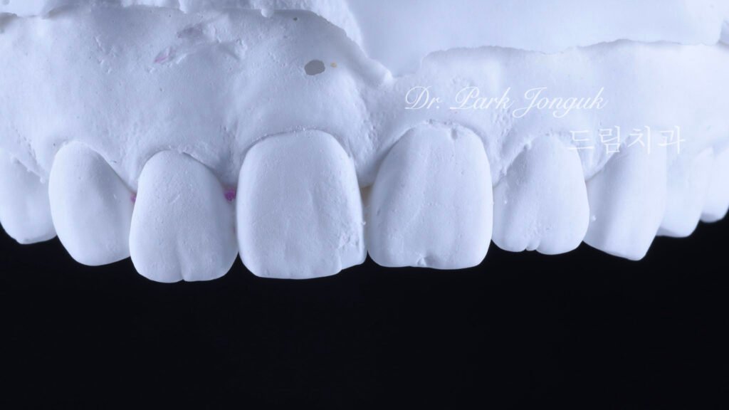 교정 후 라미네이트, Post-Orthodontic Laminate, 치아 축 기울기, Tooth Axis Inclination, 비대칭 교합 평면, Asymmetric Occlusal Plane, 교정 후 불만족, Post-Orthodontic Dissatisfaction, 치아 형태 보정, Tooth Morphology Correction