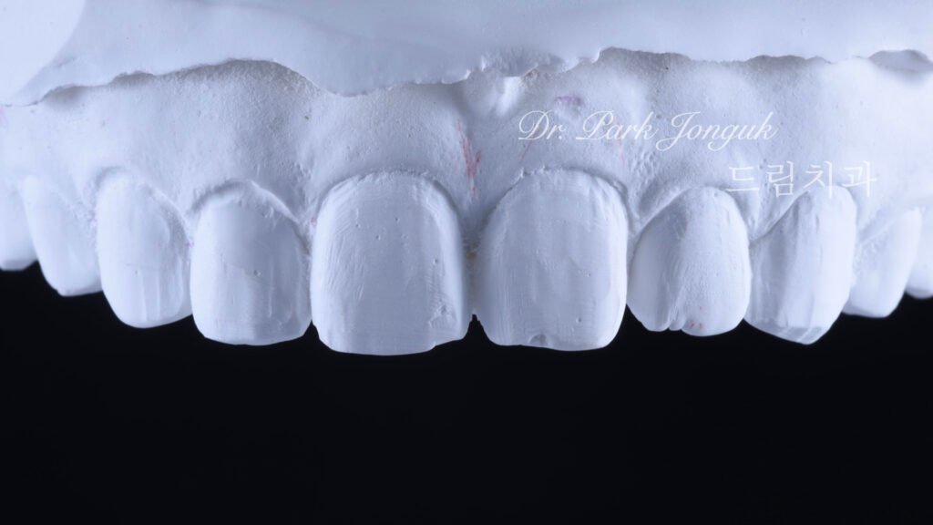교정 후 라미네이트, Post-Orthodontic Laminate, 치아 축 기울기, Tooth Axis Inclination, 비대칭 교합 평면, Asymmetric Occlusal Plane, 교정 후 불만족, Post-Orthodontic Dissatisfaction, 치아 형태 보정, Tooth Morphology Correction