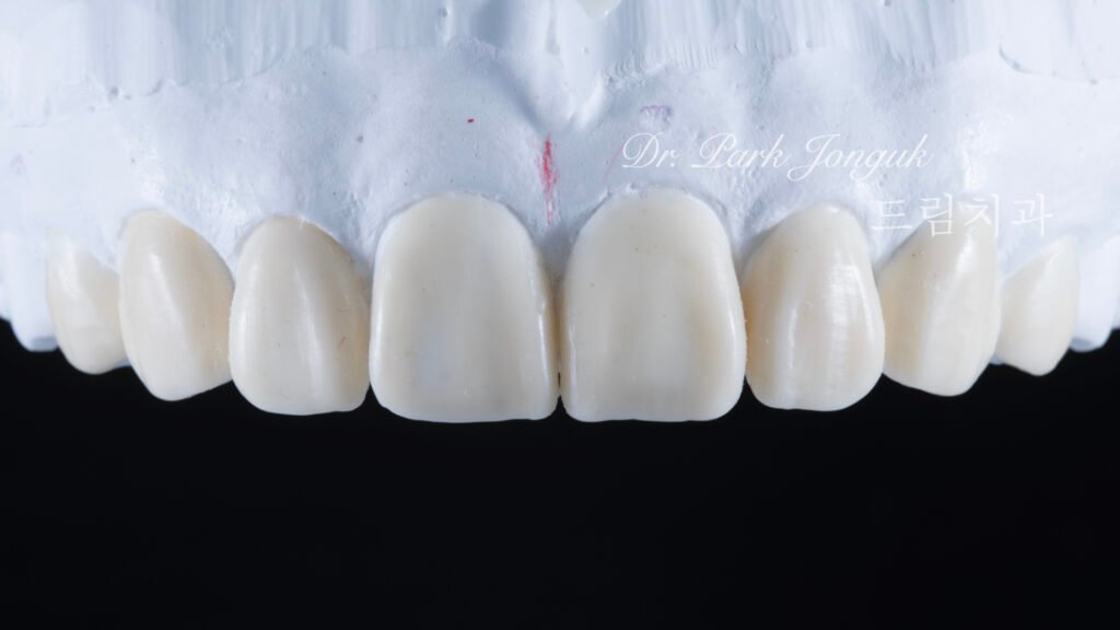 교정 후 라미네이트, Post-Orthodontic Laminate, 치아 축 기울기, Tooth Axis Inclination, 비대칭 교합 평면, Asymmetric Occlusal Plane, 교정 후 불만족, Post-Orthodontic Dissatisfaction, 치아 형태 보정, Tooth Morphology Correction