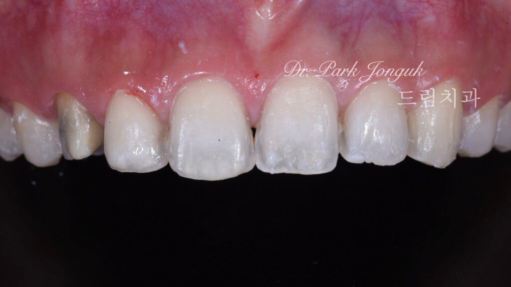 교정 후 라미네이트, Post-Orthodontic Laminate, 치아 축 기울기, Tooth Axis Inclination, 비대칭 교합 평면, Asymmetric Occlusal Plane, 교정 후 불만족, Post-Orthodontic Dissatisfaction, 치아 형태 보정, Tooth Morphology Correction