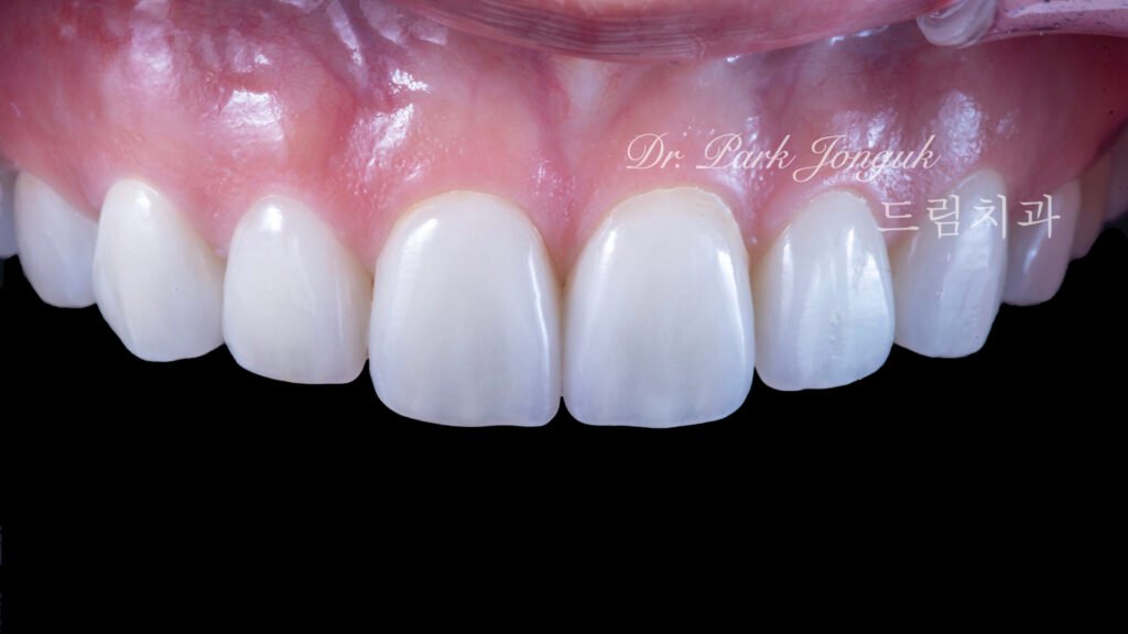 교정 후 라미네이트, Post-Orthodontic Laminate, 치아 축 기울기, Tooth Axis Inclination, 비대칭 교합 평면, Asymmetric Occlusal Plane, 교정 후 불만족, Post-Orthodontic Dissatisfaction, 치아 형태 보정, Tooth Morphology Correction