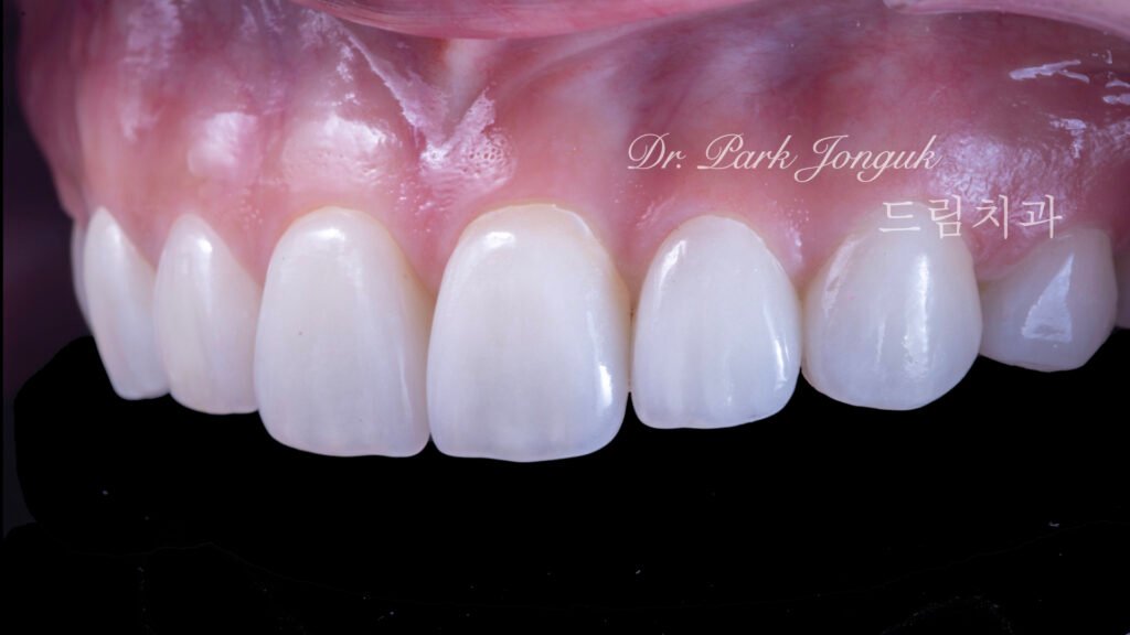 교정 후 라미네이트, Post-Orthodontic Laminate, 치아 축 기울기, Tooth Axis Inclination, 비대칭 교합 평면, Asymmetric Occlusal Plane, 교정 후 불만족, Post-Orthodontic Dissatisfaction, 치아 형태 보정, Tooth Morphology Correction