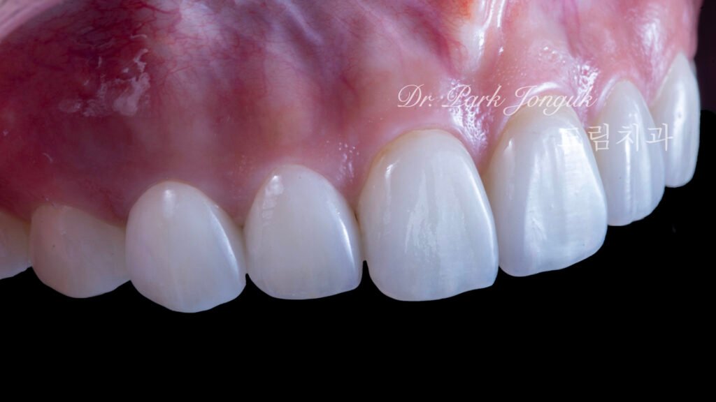 교정 후 라미네이트, Post-Orthodontic Laminate, 치아 축 기울기, Tooth Axis Inclination, 비대칭 교합 평면, Asymmetric Occlusal Plane, 교정 후 불만족, Post-Orthodontic Dissatisfaction, 치아 형태 보정, Tooth Morphology Correction