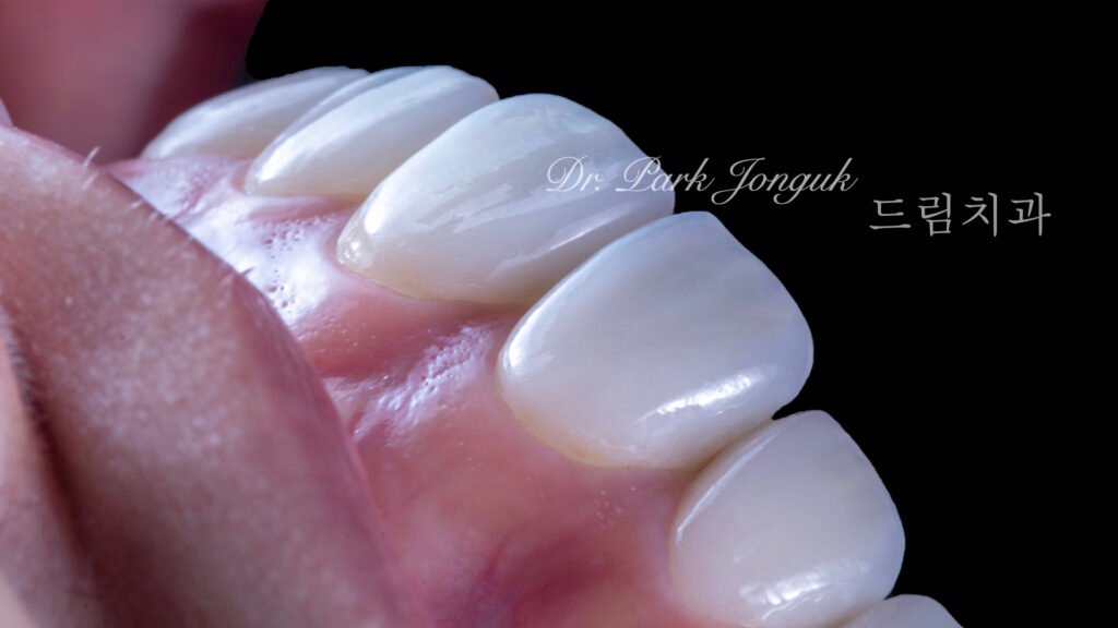 교정 후 라미네이트, Post-Orthodontic Laminate, 치아 축 기울기, Tooth Axis Inclination, 비대칭 교합 평면, Asymmetric Occlusal Plane, 교정 후 불만족, Post-Orthodontic Dissatisfaction, 치아 형태 보정, Tooth Morphology Correction