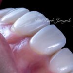 교정 후 라미네이트, Post-Orthodontic Laminate, 치아 축 기울기, Tooth Axis Inclination, 비대칭 교합 평면, Asymmetric Occlusal Plane, 교정 후 불만족, Post-Orthodontic Dissatisfaction, 치아 형태 보정, Tooth Morphology Correction