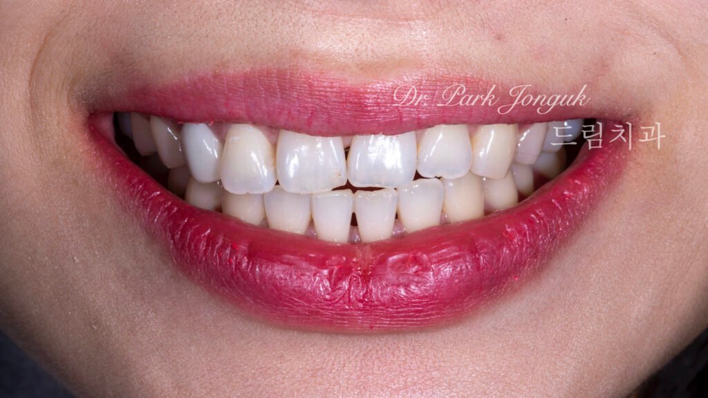 교정 후 라미네이트, Post-Orthodontic Laminate, 치아 축 기울기, Tooth Axis Inclination, 비대칭 교합 평면, Asymmetric Occlusal Plane, 교정 후 불만족, Post-Orthodontic Dissatisfaction, 치아 형태 보정, Tooth Morphology Correction