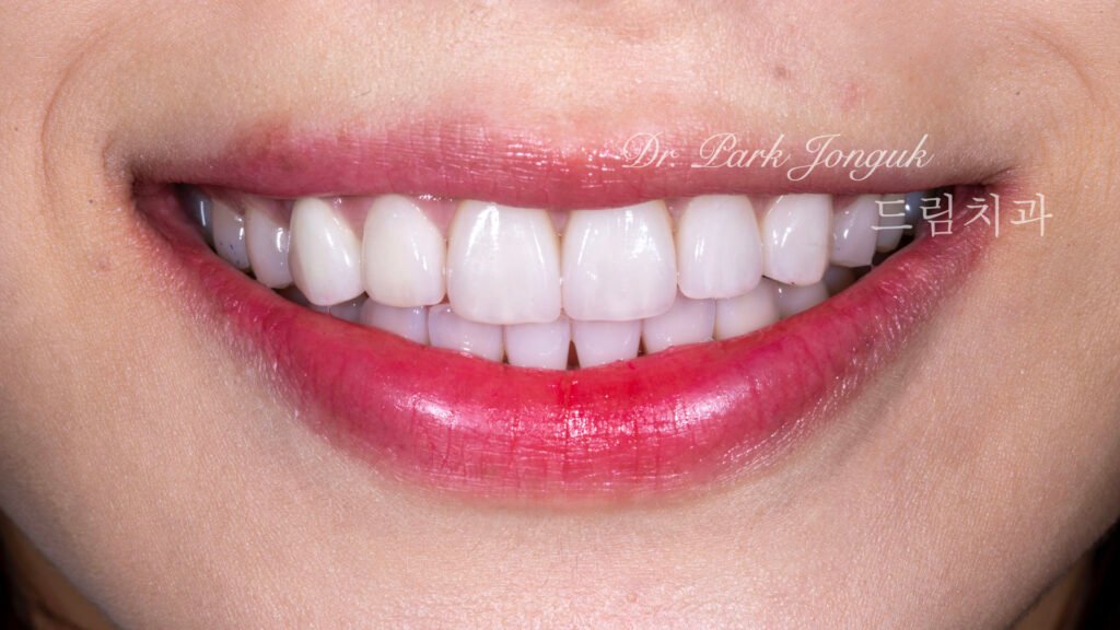 교정 후 라미네이트, Post-Orthodontic Laminate, 치아 축 기울기, Tooth Axis Inclination, 비대칭 교합 평면, Asymmetric Occlusal Plane, 교정 후 불만족, Post-Orthodontic Dissatisfaction, 치아 형태 보정, Tooth Morphology Correction