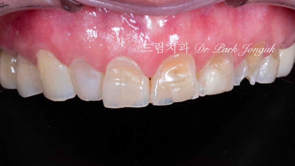 노화 치아 라미네이트, Aging Tooth Laminate, 50대 라미네이트, 60대 라미네이트, 법랑질 손실, Enamel Loss, Biomimetic, 생체모방 치과학, 치아 노화, Tooth Aging