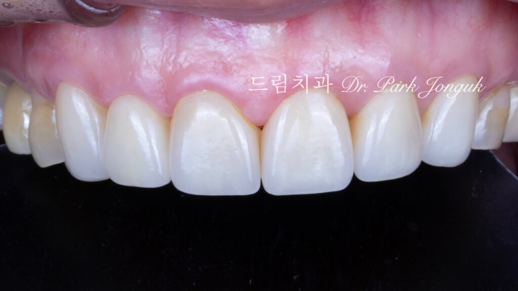 노화 치아 라미네이트, Aging Tooth Laminate, 50대 라미네이트, 60대 라미네이트, 법랑질 손실, Enamel Loss, Biomimetic, 생체모방 치과학, 치아 노화, Tooth Aging