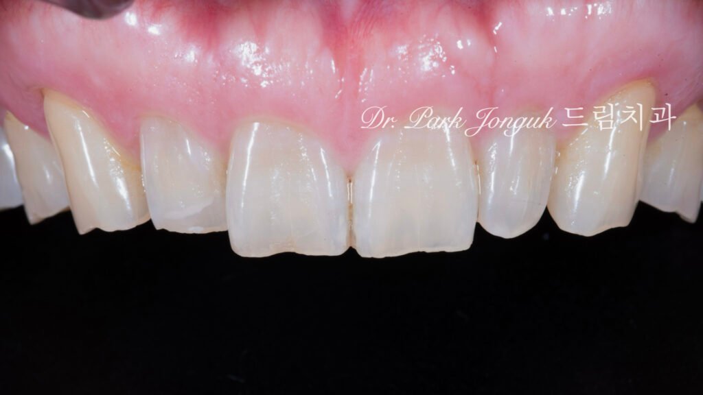 50대 라미네이트, 60대 라미네이트, 중장년층 라미네이트, 치아 누렇게, 법랑질 손실, Enamel Loss, 치아 마모, Tooth Wear, 법랑질 보충, Enamel Replacement, 리튬 디실리케이트, Lithium Disilicate