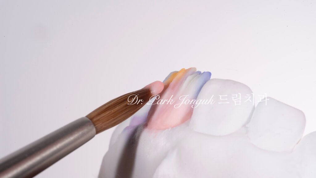 50대 라미네이트, 60대 라미네이트, 중장년층 라미네이트, 치아 누렇게, 법랑질 손실, Enamel Loss, 치아 마모, Tooth Wear, 법랑질 보충, Enamel Replacement, 리튬 디실리케이트, Lithium Disilicate