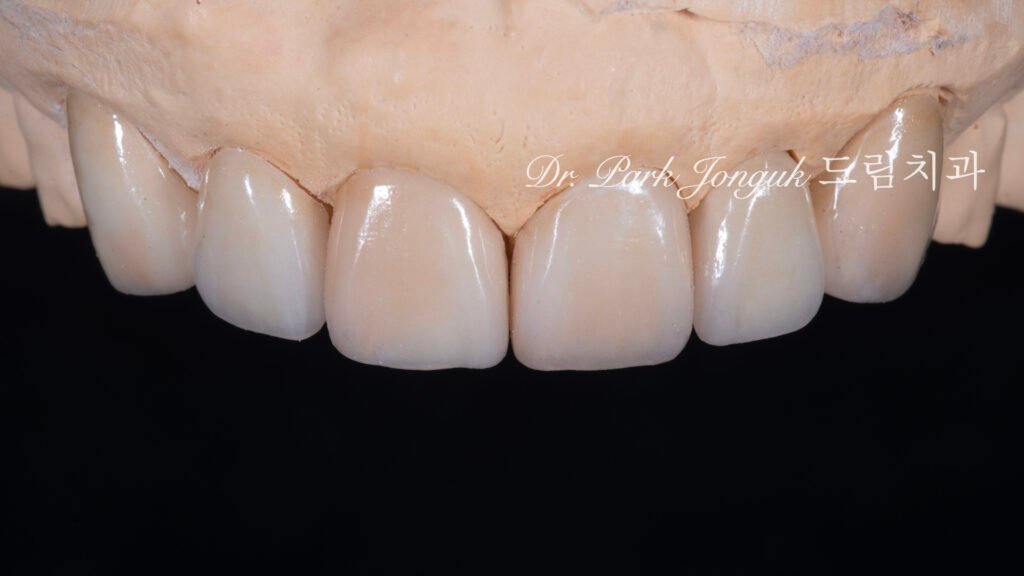 50대 라미네이트, 60대 라미네이트, 중장년층 라미네이트, 치아 누렇게, 법랑질 손실, Enamel Loss, 치아 마모, Tooth Wear, 법랑질 보충, Enamel Replacement, 리튬 디실리케이트, Lithium Disilicate