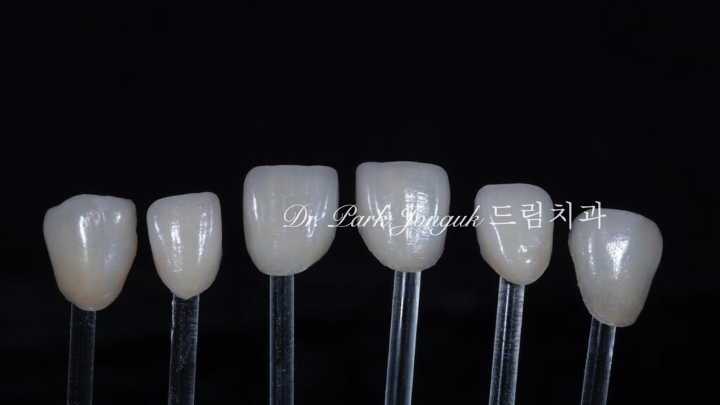 50대 라미네이트, 60대 라미네이트, 중장년층 라미네이트, 치아 누렇게, 법랑질 손실, Enamel Loss, 치아 마모, Tooth Wear, 법랑질 보충, Enamel Replacement, 리튬 디실리케이트, Lithium Disilicate